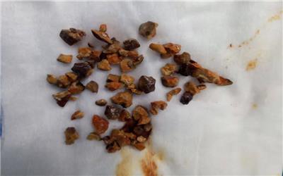 نخستین جراحی پیشرفته خارج نمودن سنگ کلیه از راه پوست