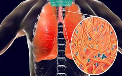 هشدار دانشگاه علوم پزشکی تربت‌حیدریه نسبت به شیوع بیماری سیاه‌سرفه